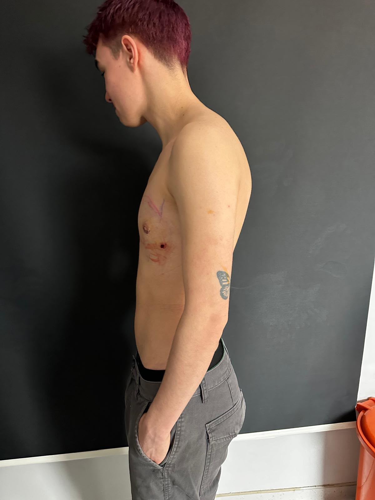 Keyhole top surgery result photo