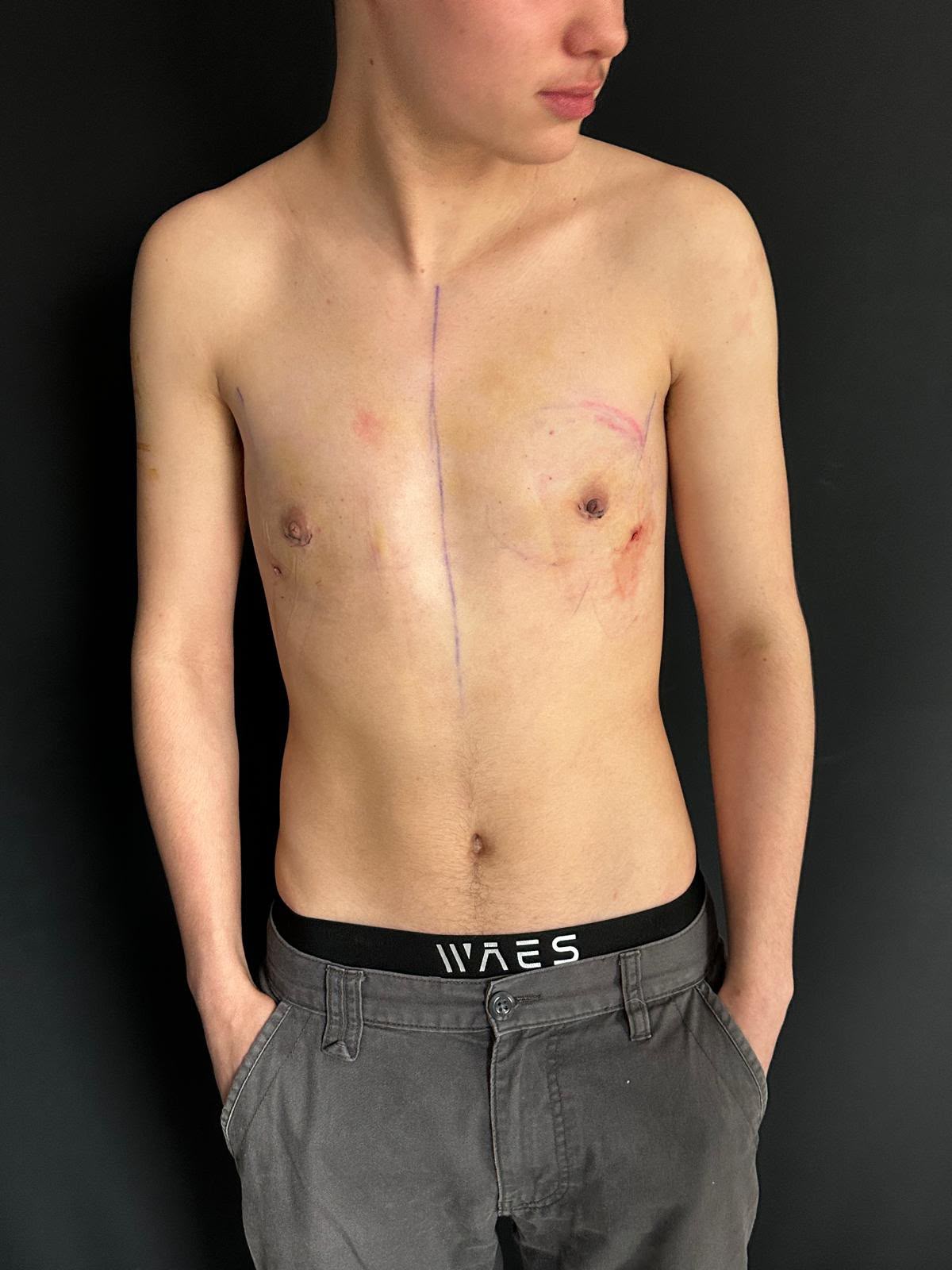 Keyhole top surgery result photo