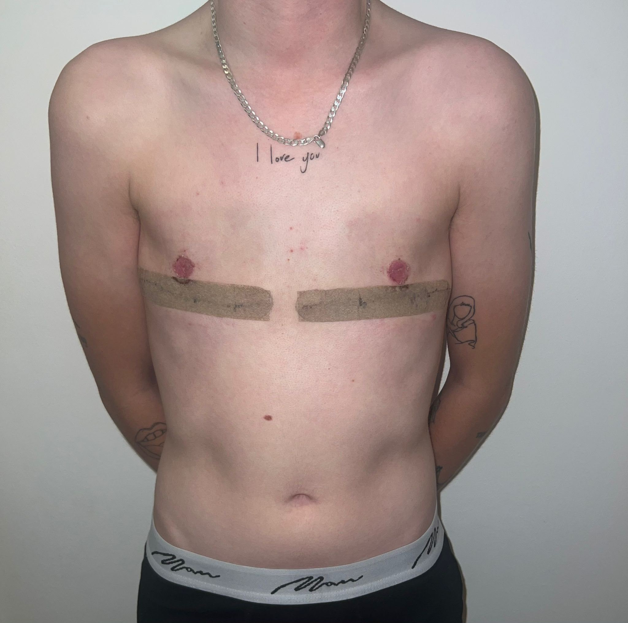Double incision top surgery result photo