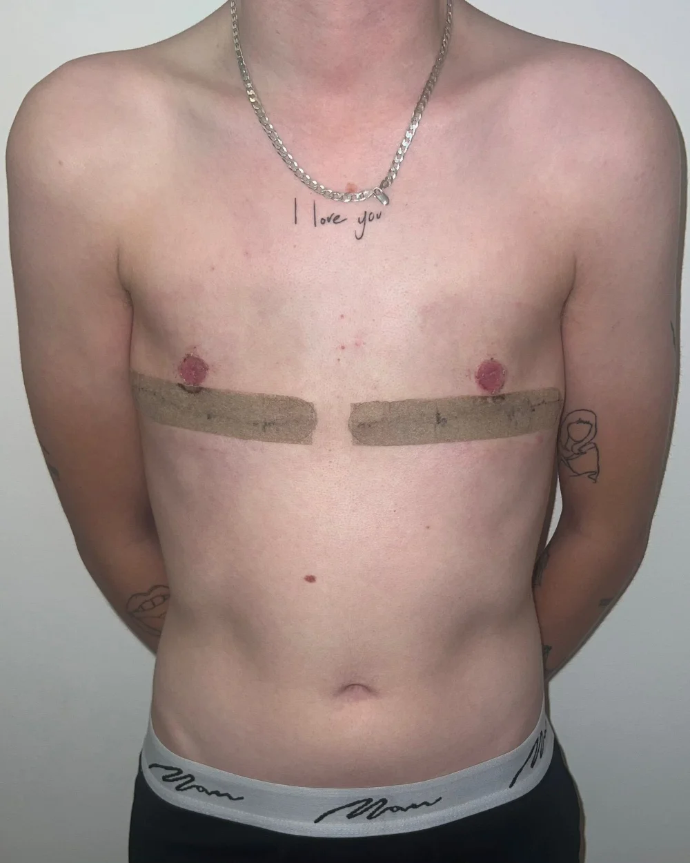 Double incision top surgery — example result