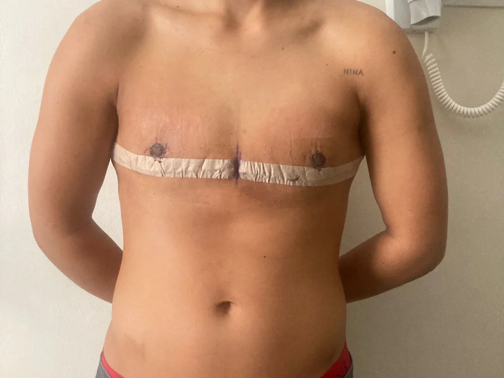 Top surgery revision — example case