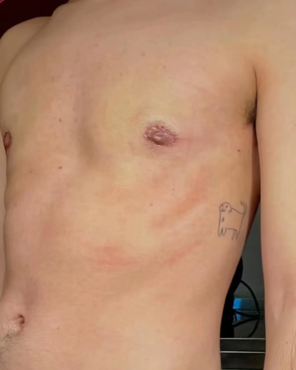 Keyhole top surgery — example result